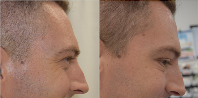 Crows feet treated with botox.