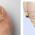 Infecciones por hongos en las uñas.
