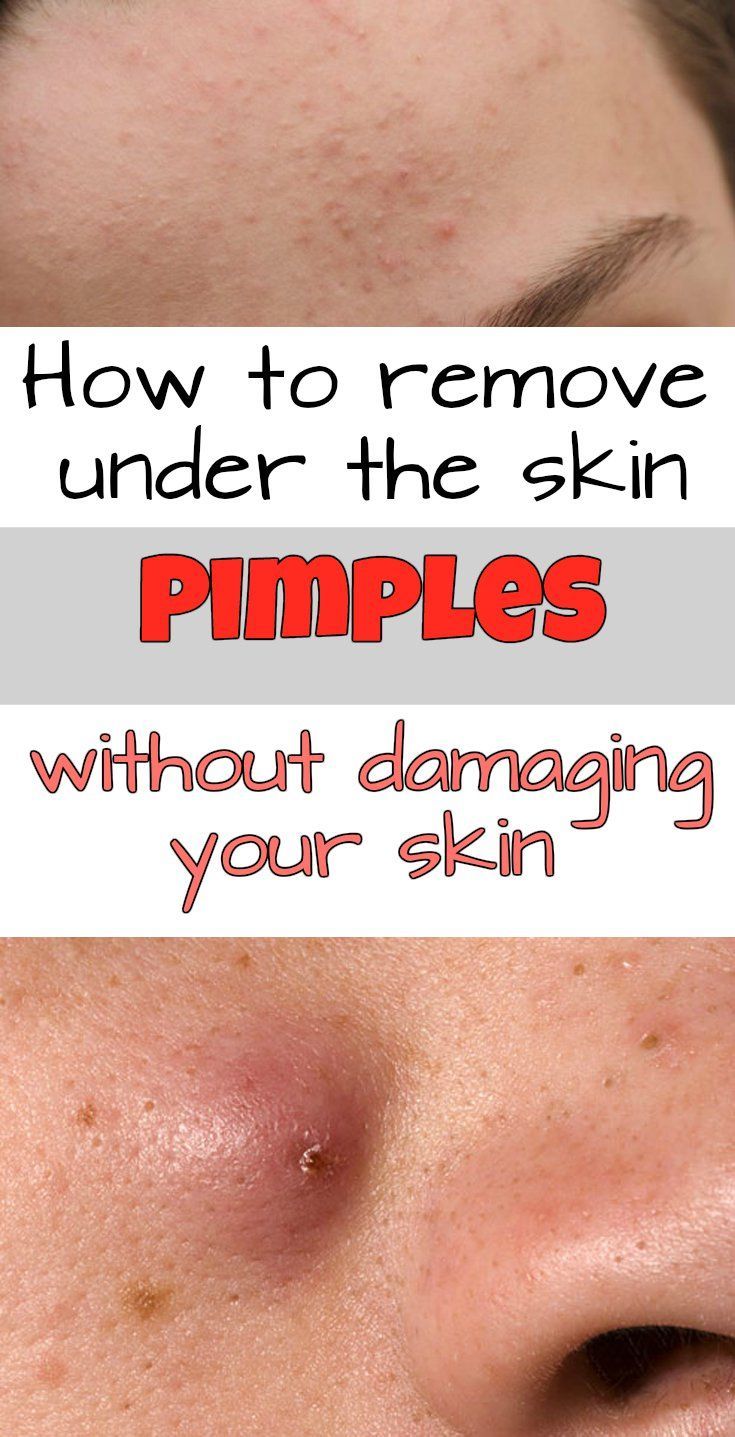 Remove Under The Skin Pimples Without Damaging Your Skin Healthy