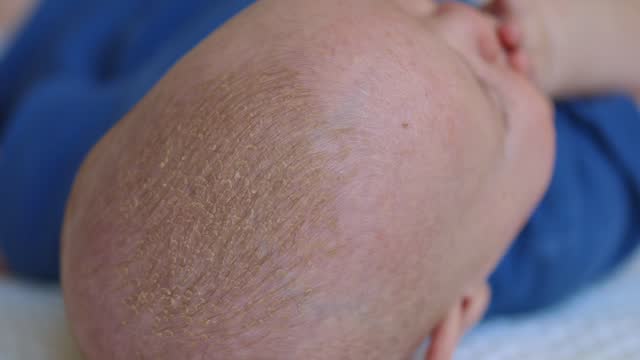 baby with a dry scalp baby with a dry scalp