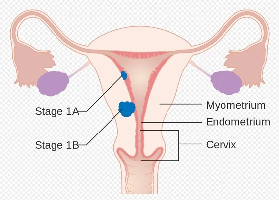 Askep Kanker Rahim atau Endometrium