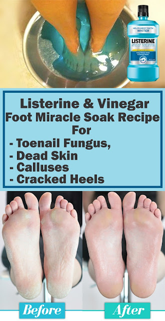 Listerine & Vinegar Foot Miracle Soak Recipe for Toenail Fungus, Dead