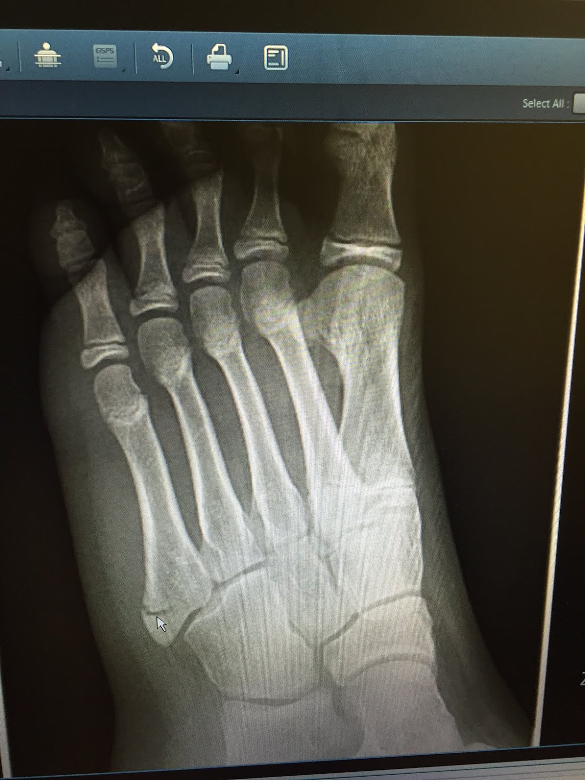interior castle 5th metatarsal tuberosity fracture