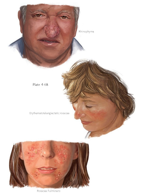 Rosacea is an extremely common chronic dermatosis