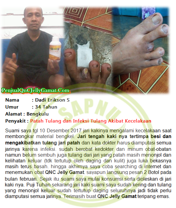 Cara Mengobati Nyeri Tumit Kaki Kanan dan Kiri Secara Alami Sampai Tuntas Cara Mengobati Nyeri Tumit Kaki Kanan dan Kiri Secara Alami Sampai Tuntas