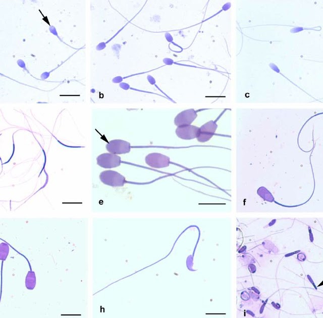 The abnormal sperm morphology racket for overreporting