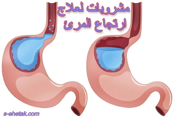 مشروبات لعلاج ارتجاع المرئ