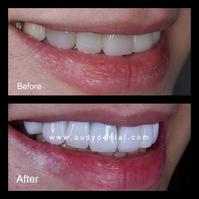 Harga Veneer Gigi Terbaru dan Lengkap dengan Manfaat Melakukan Veneer Gigi