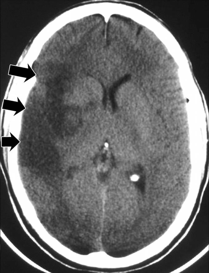 Basal Ganglia Anatomy Radiology