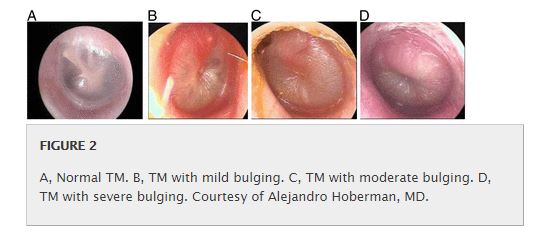 Otitis Media Nuevo Tratamiento Para Viejo Conocido Colotordoc