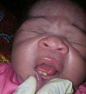 VIRAL PHOTO: A Day Old Baby Born With Teeth 