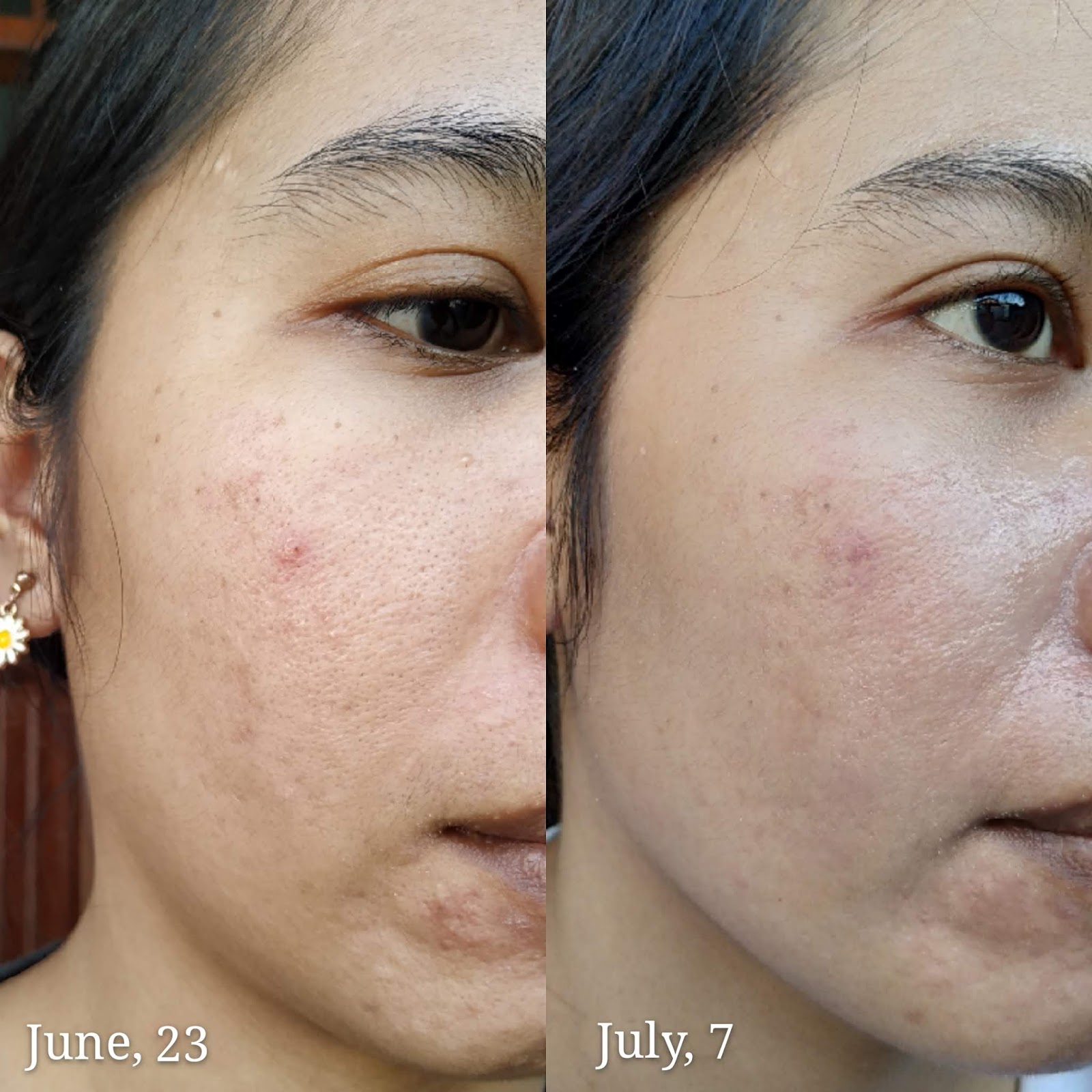 BENTON PHA PEELING GEL THE BEST PEELING GEL FOR SENSITIVE ACNE PRONE