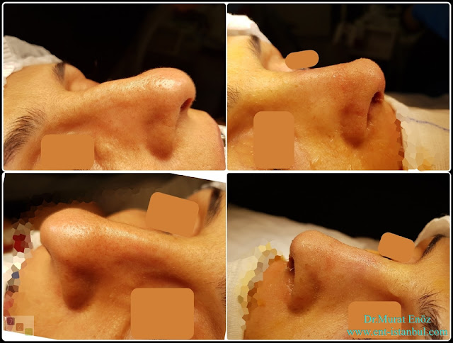 Nose Tip Plasty, Dorsal Hump Reduction, Hump Removal, Nose Tip Lifting