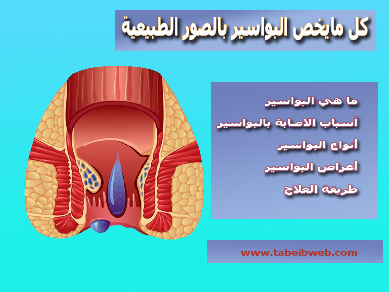 كل مايخص البواسير بالصور الطبيعية طبيب ويب