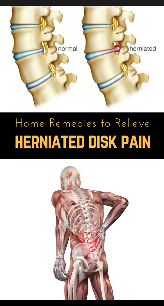Home Remedies To Relieve Herniated Disc Pain Wellness True