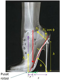 Gambar 3: Foto sinar-X kondisi kaki ketika menggunakan high heels