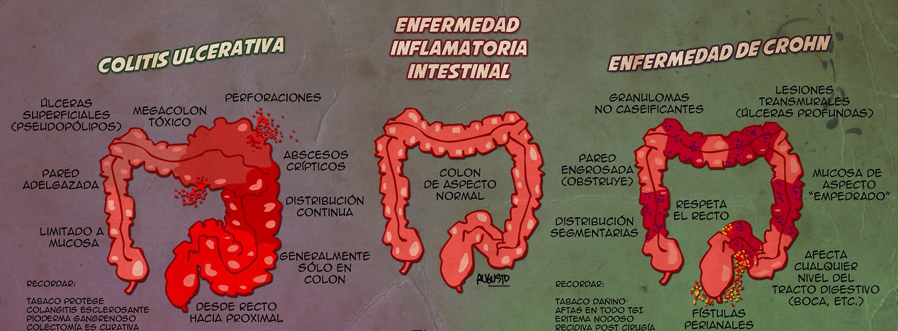 Aguacate y colitis