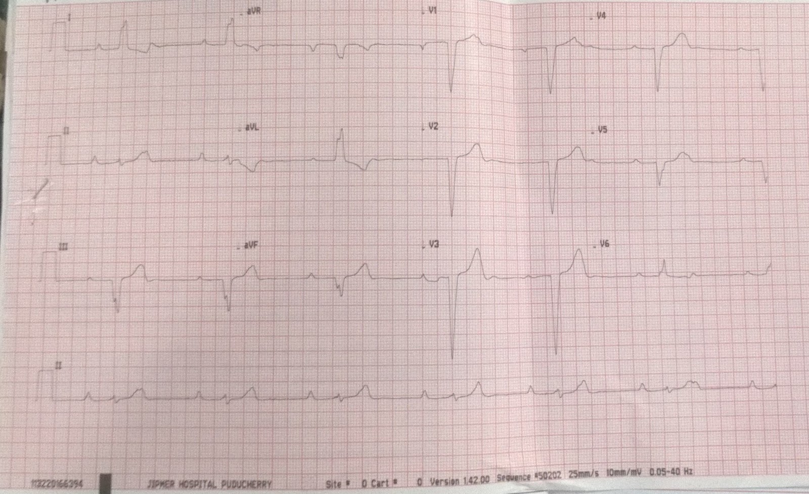 Cardiology window Complete heart block ecg