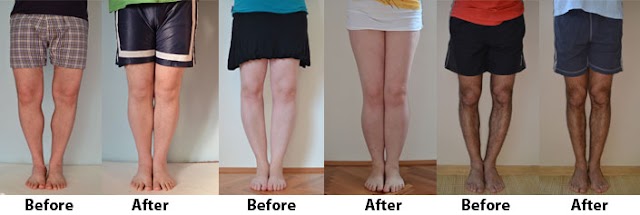 Straighten Bowed Legs Naturally At Home- Easy and Painless