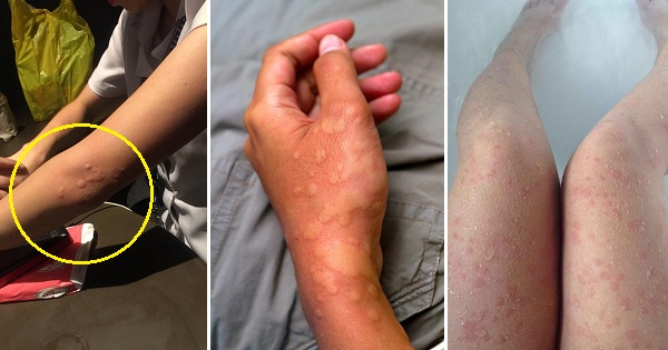 Netizen warns of the dangers from cold urticaria