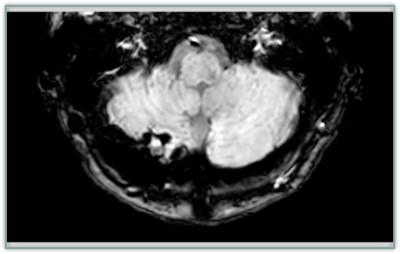 Cerebellum After Brain Surgery