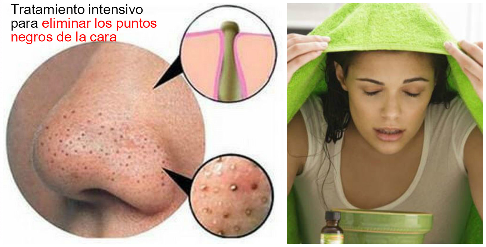La loción para la persona weleda dermalotion de las anguillas y los granos