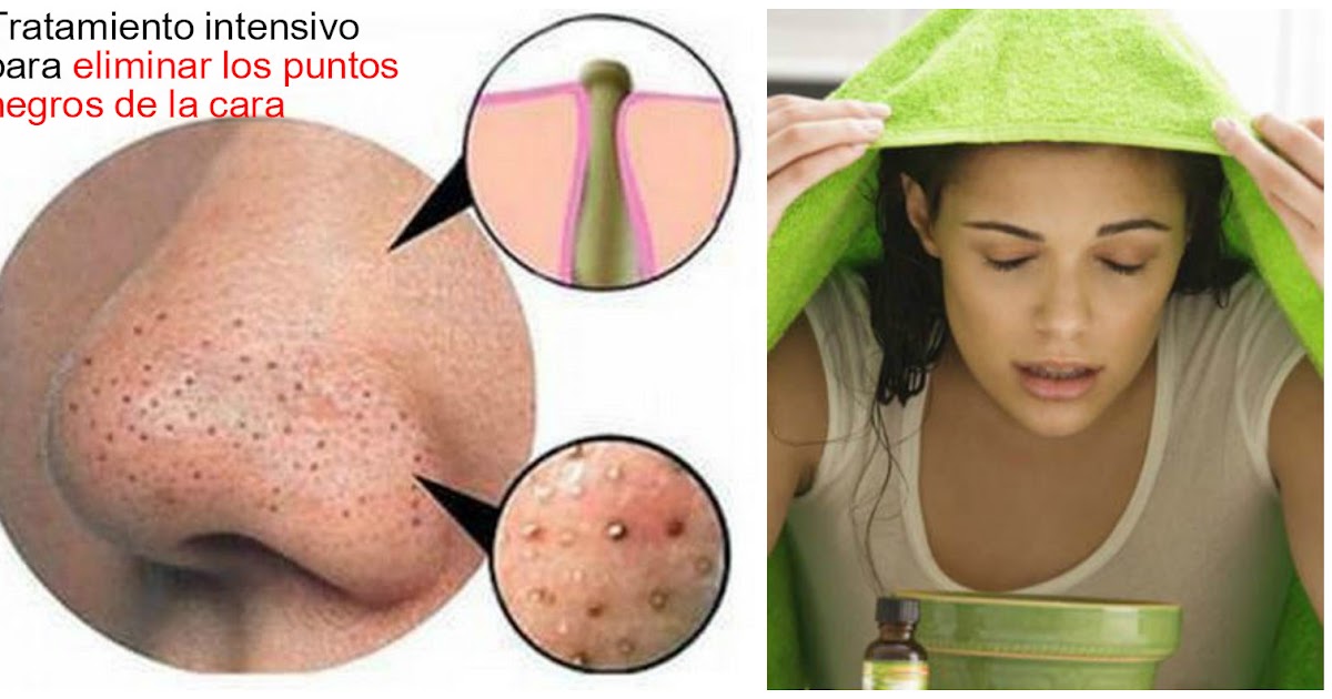 Dieta para eliminar el acne en 3 dias