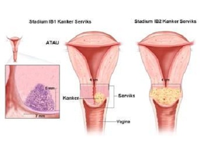 Penyakit Pada Sistem Reproduksi Manusia Beserta Gejala Dan Cara Pencegahannya Pustakapengetahuan Com