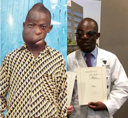 00 Photos: Ostracized, treated as an outcast, Nigerian man born with face tumour now a 4th year medical student in the US