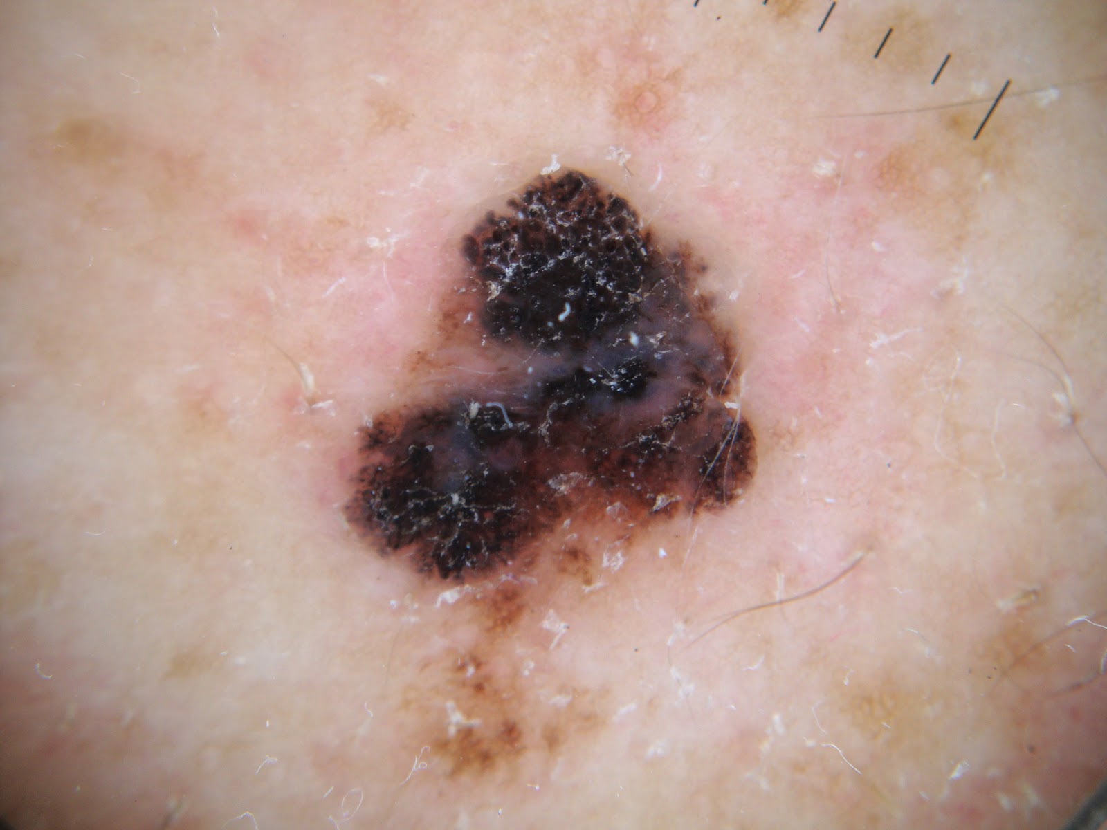 Skin Cancer - Melanoma: Overview, Diagnosis, Treatment ...