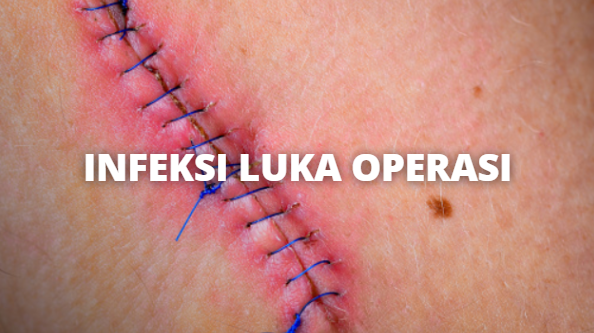 Gambar Infeksi Luka Operasi - Homecare24