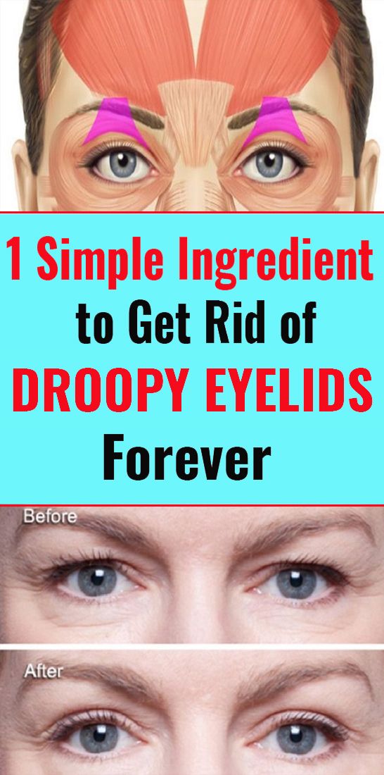 One Simple Ingredient to Get Rid of Droopy Eyelids Forever xavidream