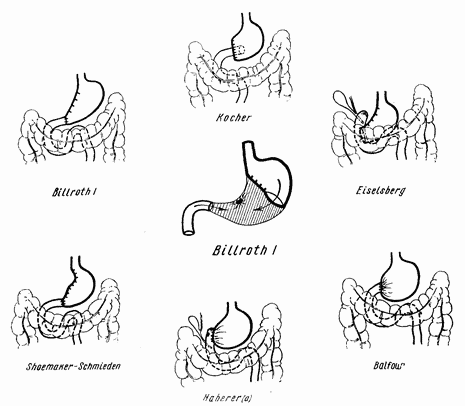 Схема резекции желудка. Бильрот 2 в модификации Витебского. Схема резекции желудка по Бильрот II. Резекция желудка по Бильрот 2 в модификации Витебского.