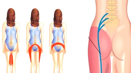 bel fitiginda bacak agrisi nasil gecer