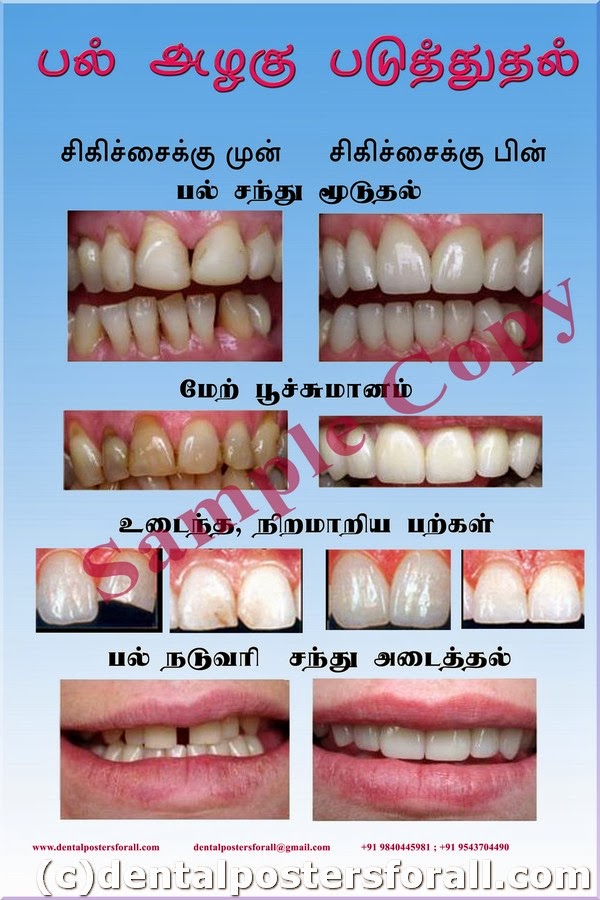 Dental Posters to Educate Patients Cosmetic Dentistry in Tamil