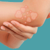 Kode ICD 10 DKA, Dermatitis Kontak Alergi