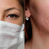 Aprenda a prevenir e tratar a acne causada pelo uso de máscaras