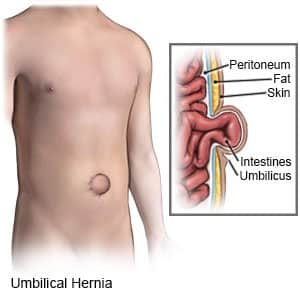 umbilical hernia