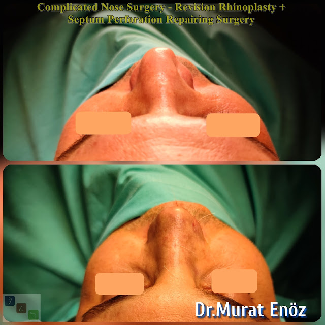 Complicated rhinoplasty, nasal septum perforation closore surgery,2nd Revision Male Rhinoplasty,Closure of nasal septum perforation with rib cartilage,