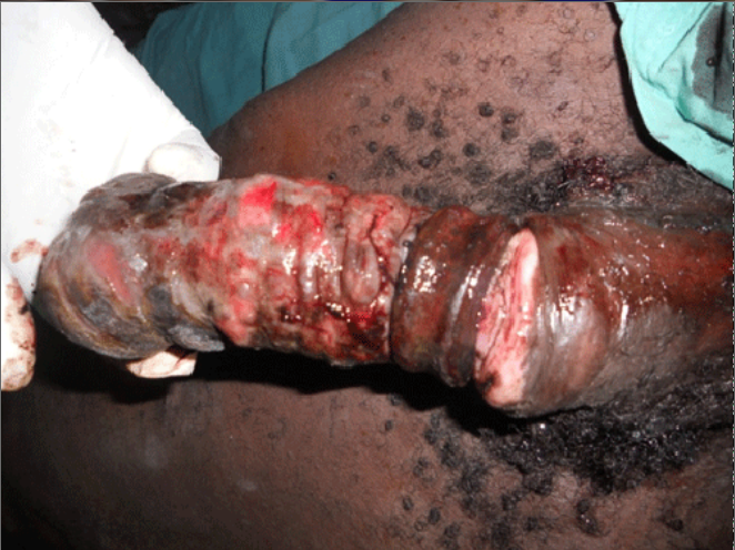 Pictures Of Infected Penis 4