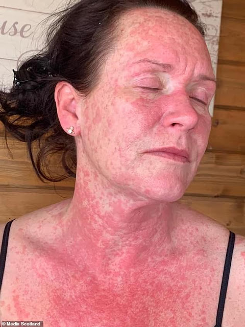 Shocking Photos of a Mom as she Suffers Rash All Over her body after taking the AstraZeneca Vaccine