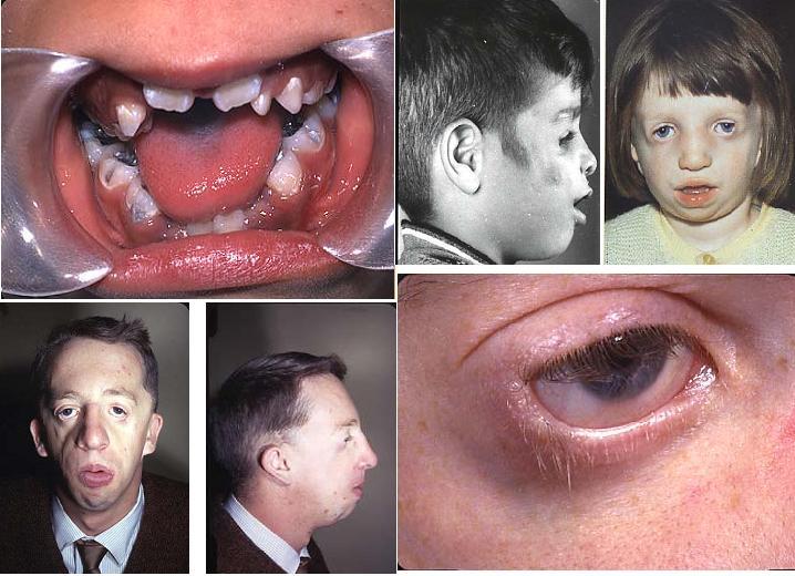 Dentistry lectures for MFDS/MJDF/NBDE/ORE A Lecture Note On Inherited