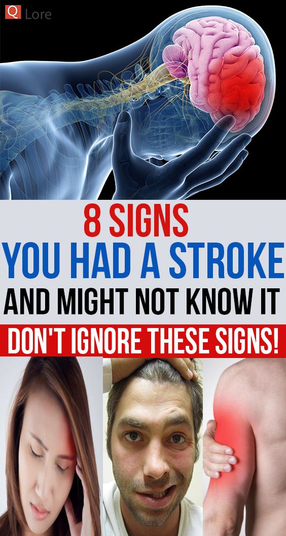 8 Signs You Had A Stroke And Might Not Know It Dont Ignore These