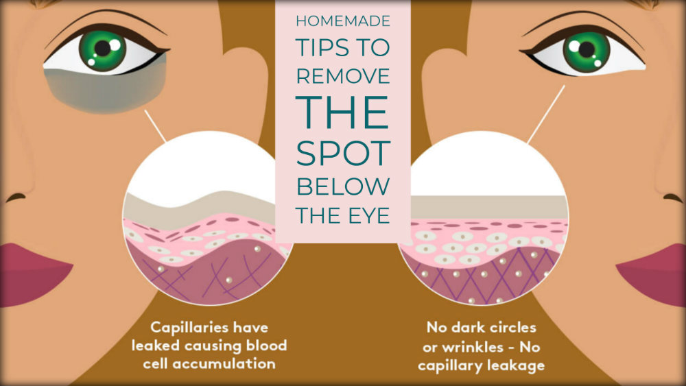 Are You In Tension With Dark Circles? Take a Look to Some Homemade Tips