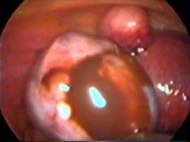 Endometrioma (Chocolate cyst) by laparoscopy -done by Dr. Alaa Mosbah