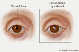 Hasil gambar untuk gangguan pada penglihatan mata