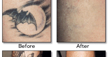 top tattoo art laser tattoo removal cost estimate top tattoo art laser tattoo removal cost estimate