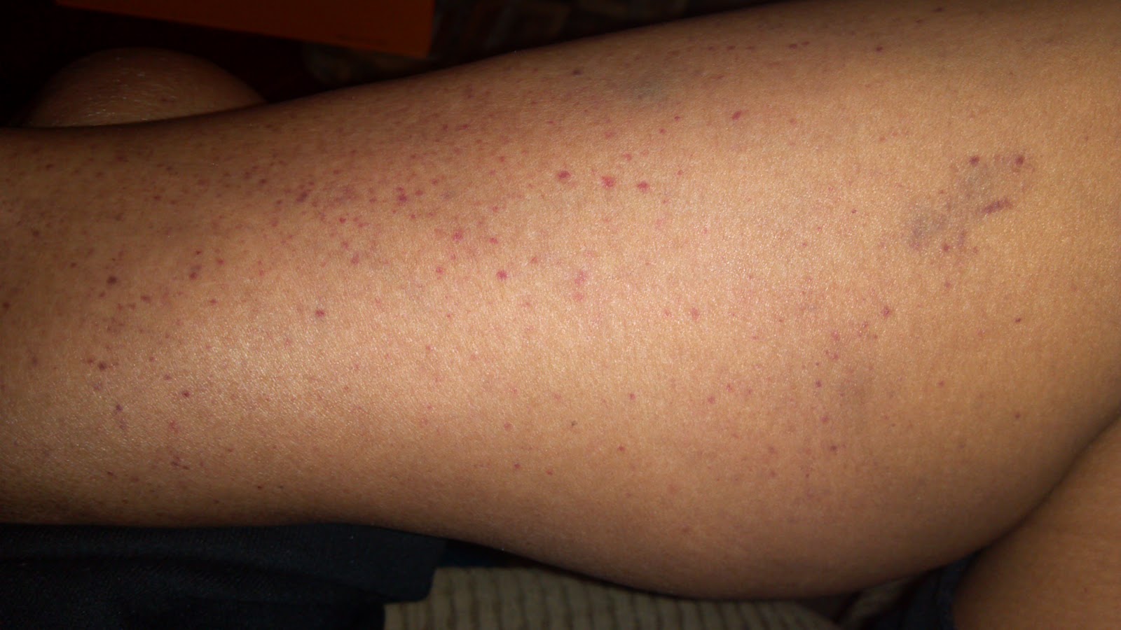 Round Red Spots On Legs Pictures Photos