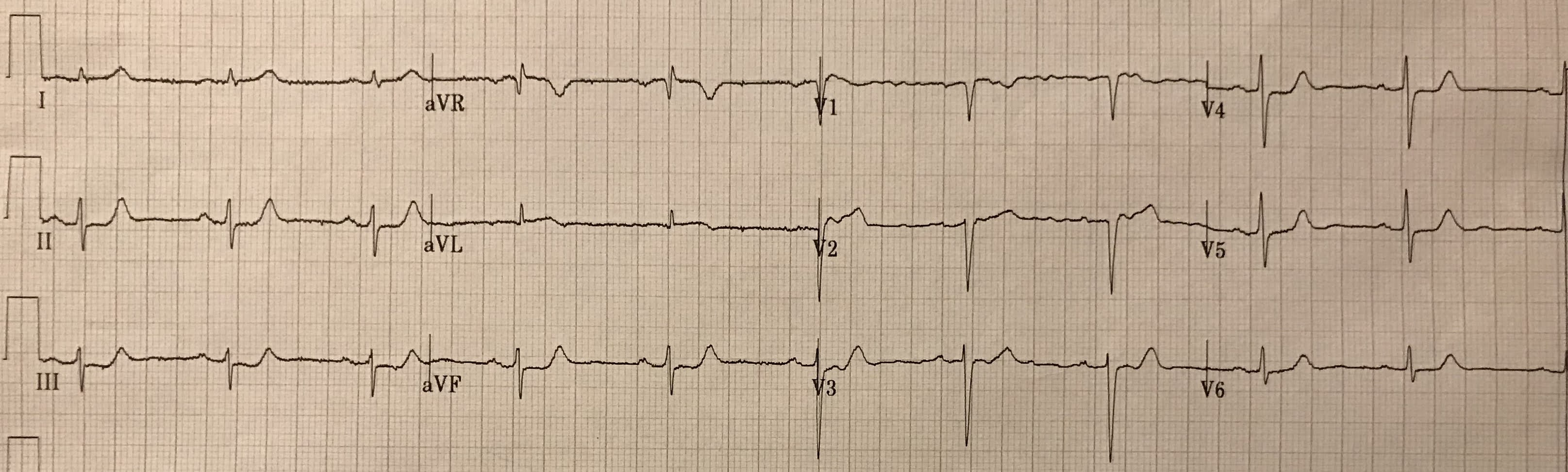 Dr. Smith's ECG Blog The cardiologist disagreed with cath lab