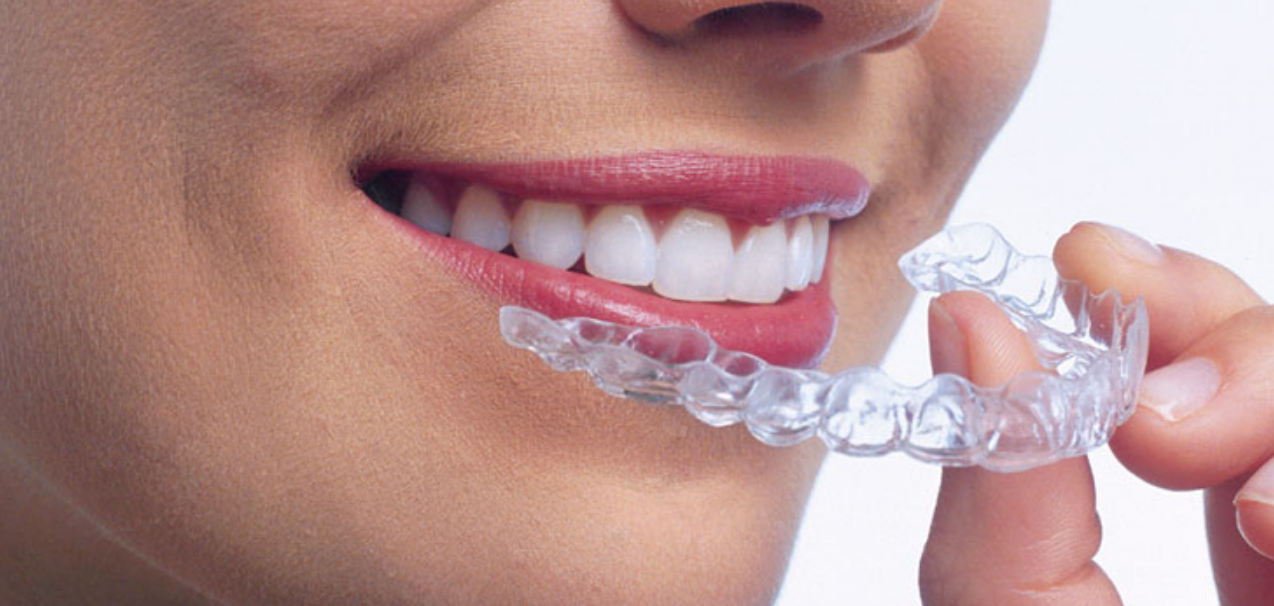 تقويم الاسنان الشفاف المميزات والأنواع والأسعار